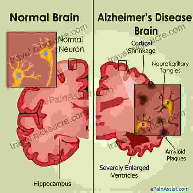 Alzheimer's Disease Affects Memory And Cognition Decoding Darkness: The Search For The Genetic Causes Of Alzheimer S Disease